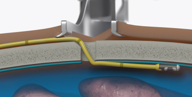sensor_place_subdural